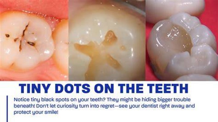 Can black spots on teeth go away?