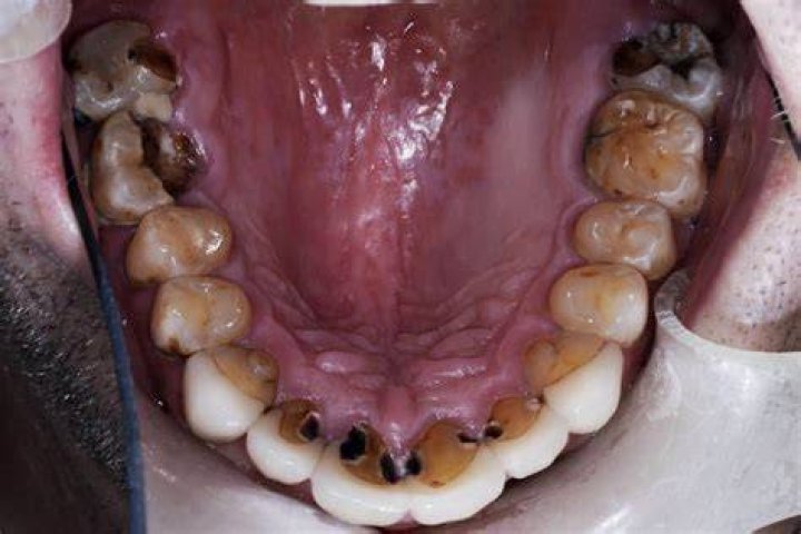 Can you smell a rotten tooth?