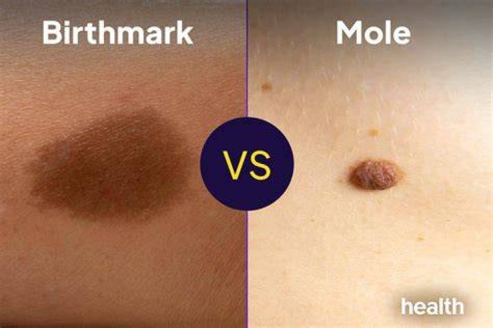 Is a birthmark a mole?