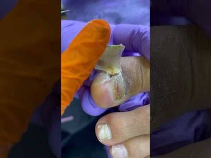 Why do my big toenails hurt after wearing shoes?