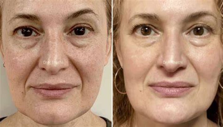 Will microdermabrasion remove freckles?
