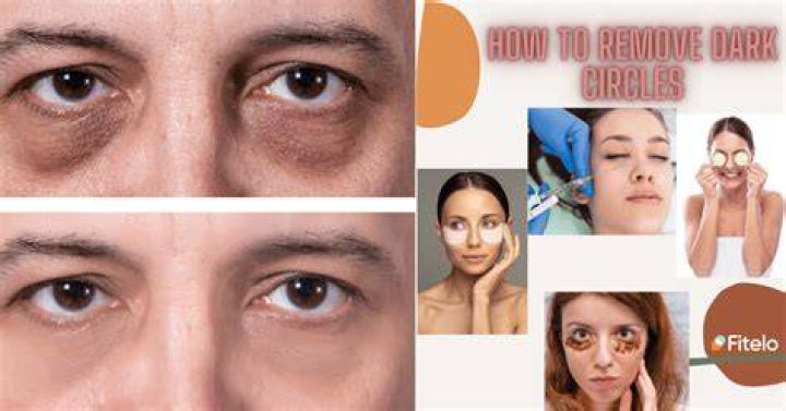 Will my dark circles go away after quitting smoking?